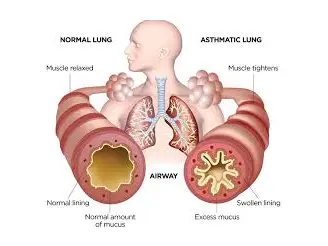 Bronchial Asthma